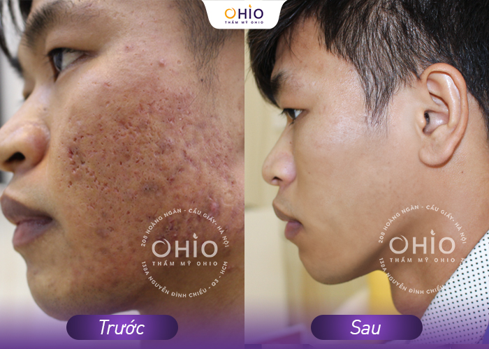 Trị mụn kháng khuẩn đa tầng Azumino Acne - sạch mụn đánh bật vết thâm - Phòng khám da liễu OHIO Trị mụn kháng khuẩn đa tầng Azumino Acne - sạch mụn đánh bật vết thâm