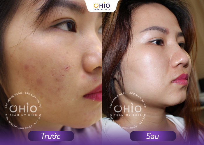 Trị mụn kháng khuẩn đa tầng Azumino Acne - sạch mụn đánh bật vết thâm - Phòng khám da liễu OHIO Trị mụn kháng khuẩn đa tầng Azumino Acne - sạch mụn đánh bật vết thâm