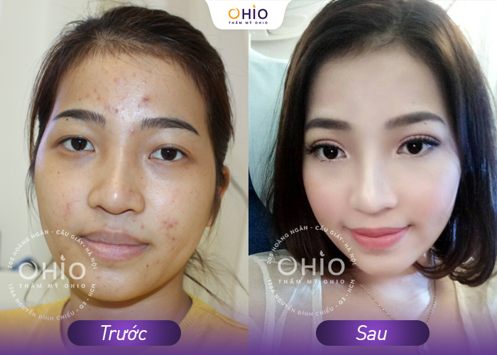 Trị mụn kháng khuẩn đa tầng Azumino Acne - sạch mụn đánh bật vết thâm - Phòng khám da liễu OHIO Trị mụn kháng khuẩn đa tầng Azumino Acne - sạch mụn đánh bật vết thâm