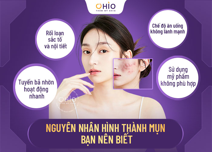 Trị mụn kháng khuẩn đa tầng Azumino Acne - sạch mụn đánh bật vết thâm