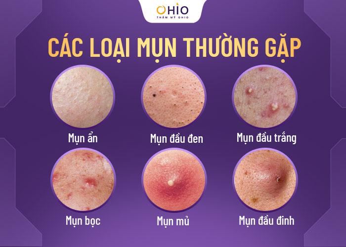 Trị mụn kháng khuẩn đa tầng Azumino Acne - sạch mụn đánh bật vết thâm