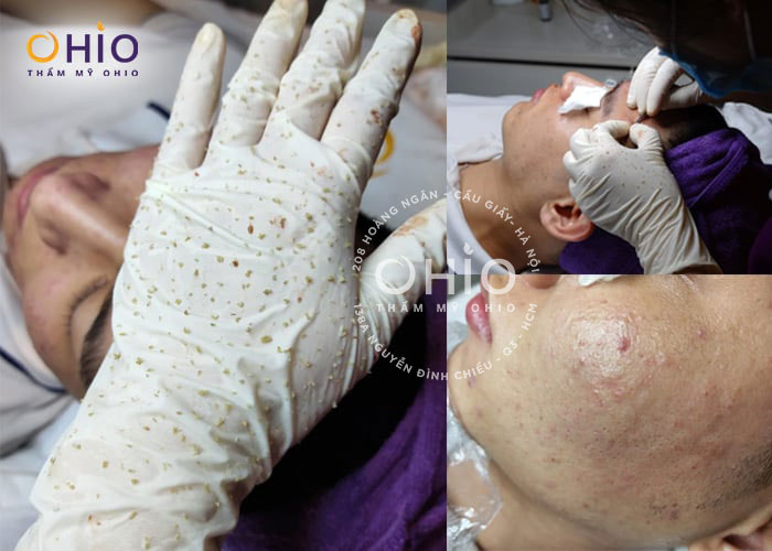 Trị mụn kháng khuẩn đa tầng Azumino Acne - sạch mụn đánh bật vết thâm - Phòng khám da liễu OHIO Trị mụn kháng khuẩn đa tầng Azumino Acne - sạch mụn đánh bật vết thâm