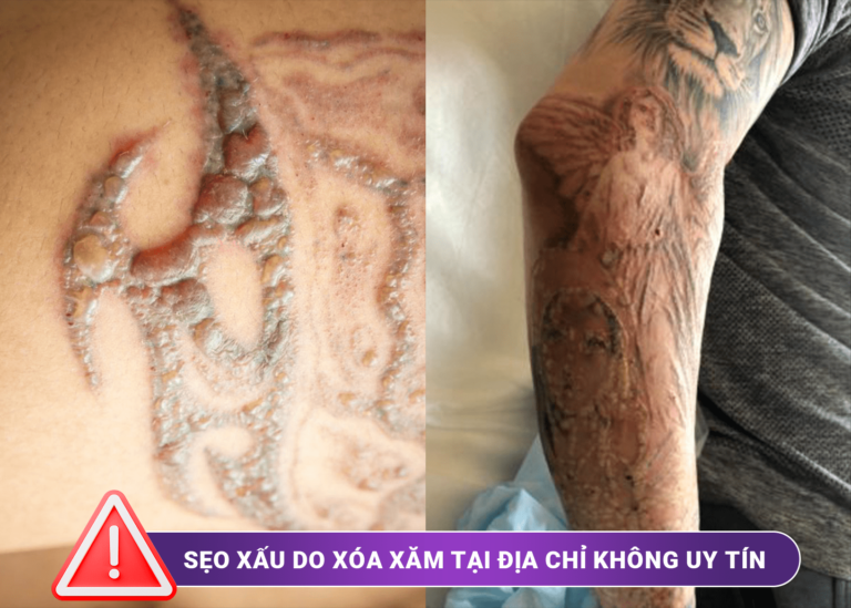 Biến chứng xóa xăm do điều trị sai cách