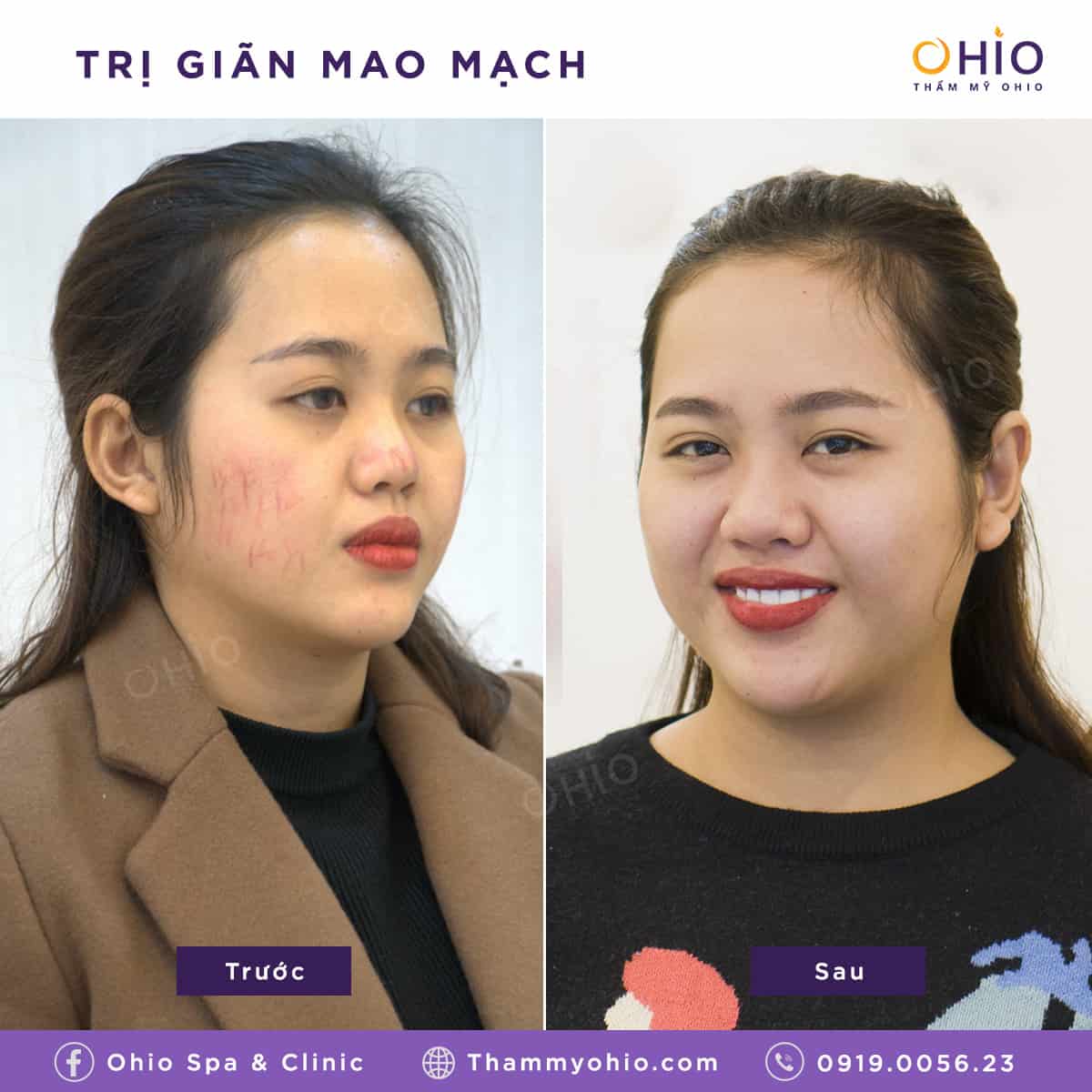 Bạn đã biết phương pháp trị giãn mao mạch hiệu quả, thời gian tức thì?