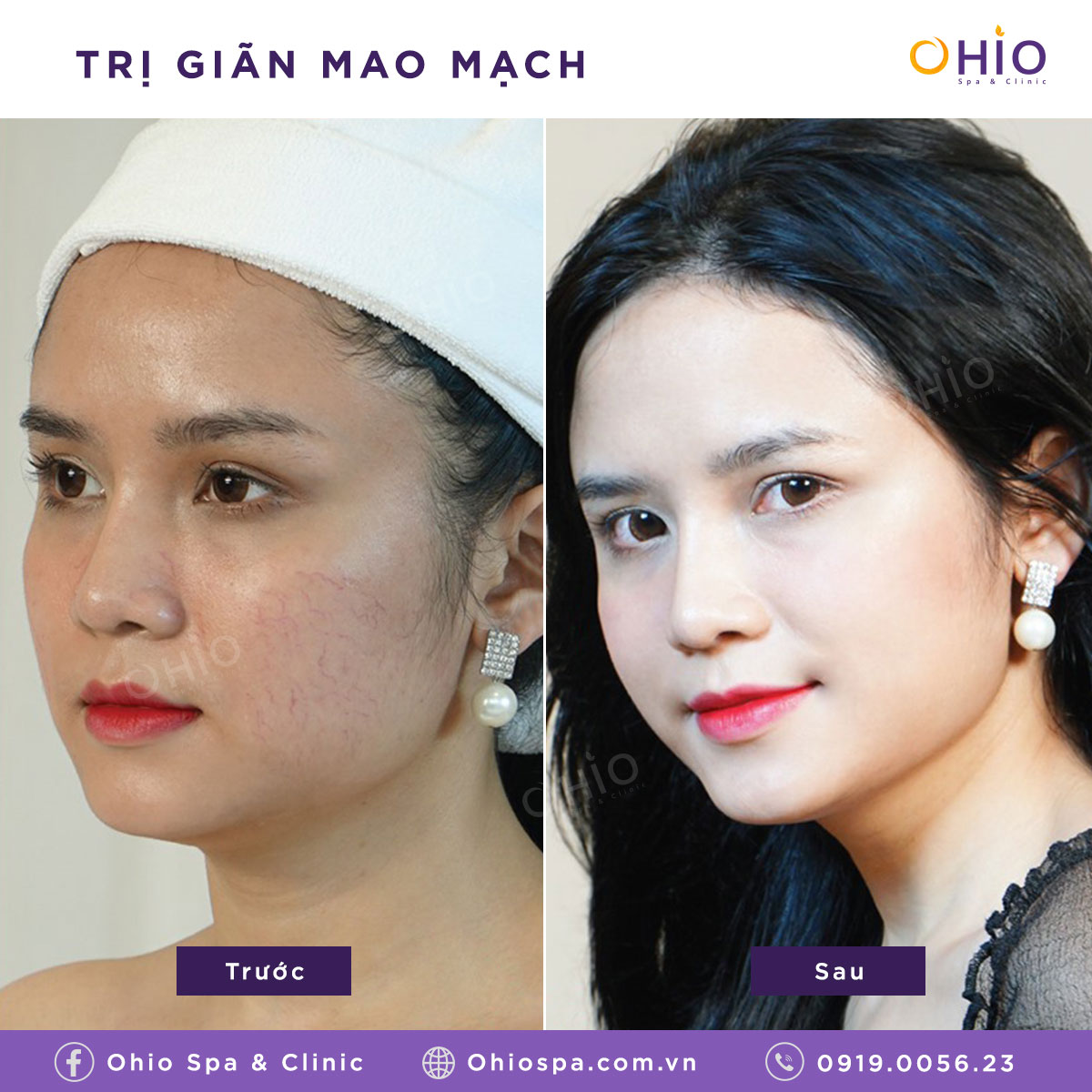 Trị giãn mao mạch ở đâu tốt & có thể “xóa sổ” ? - Phòng khám da liễu OHIO Trị giãn mao mạch ở đâu tốt & có thể “xóa sổ” ?