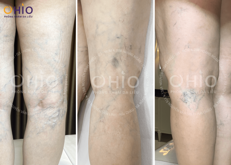 Trị giãn mao mạch ở OHIO bằng phương pháp nào, có hiệu quả không?