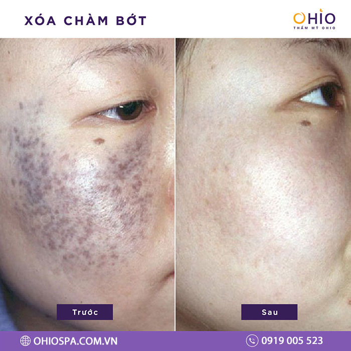 Chàm bớt xanh đen và đỏ có gì khác & phương pháp điều trị chấm dứt - Phòng khám da liễu OHIO Chàm bớt xanh đen và đỏ có gì khác & phương pháp điều trị chấm dứt