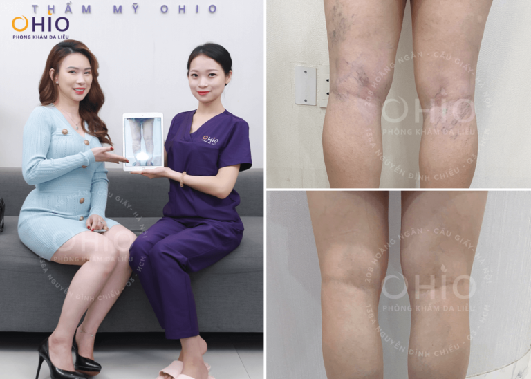 Dấu hiệu giãn mao mạch và cách điều trị an toàn, hiệu quả - Phòng khám da liễu OHIO Dấu hiệu giãn mao mạch và cách điều trị an toàn, hiệu quả