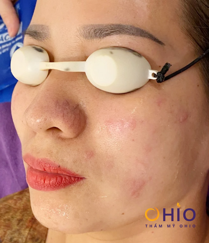 Giãn mao mạch có nguy hiểm không & cách điều trị hiệu quả - Phòng khám da liễu OHIO Giãn mao mạch có nguy hiểm không & cách điều trị hiệu quả