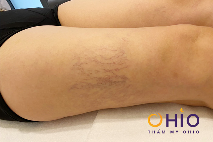 Giãn mao mạch có nguy hiểm không & cách điều trị hiệu quả - Phòng khám da liễu OHIO Giãn mao mạch có nguy hiểm không & cách điều trị hiệu quả