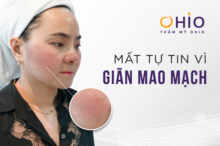 Giãn mao mạch có nguy hiểm không & cách điều trị hiệu quả - Phòng khám da liễu OHIO Giãn mao mạch có nguy hiểm không & cách điều trị hiệu quả