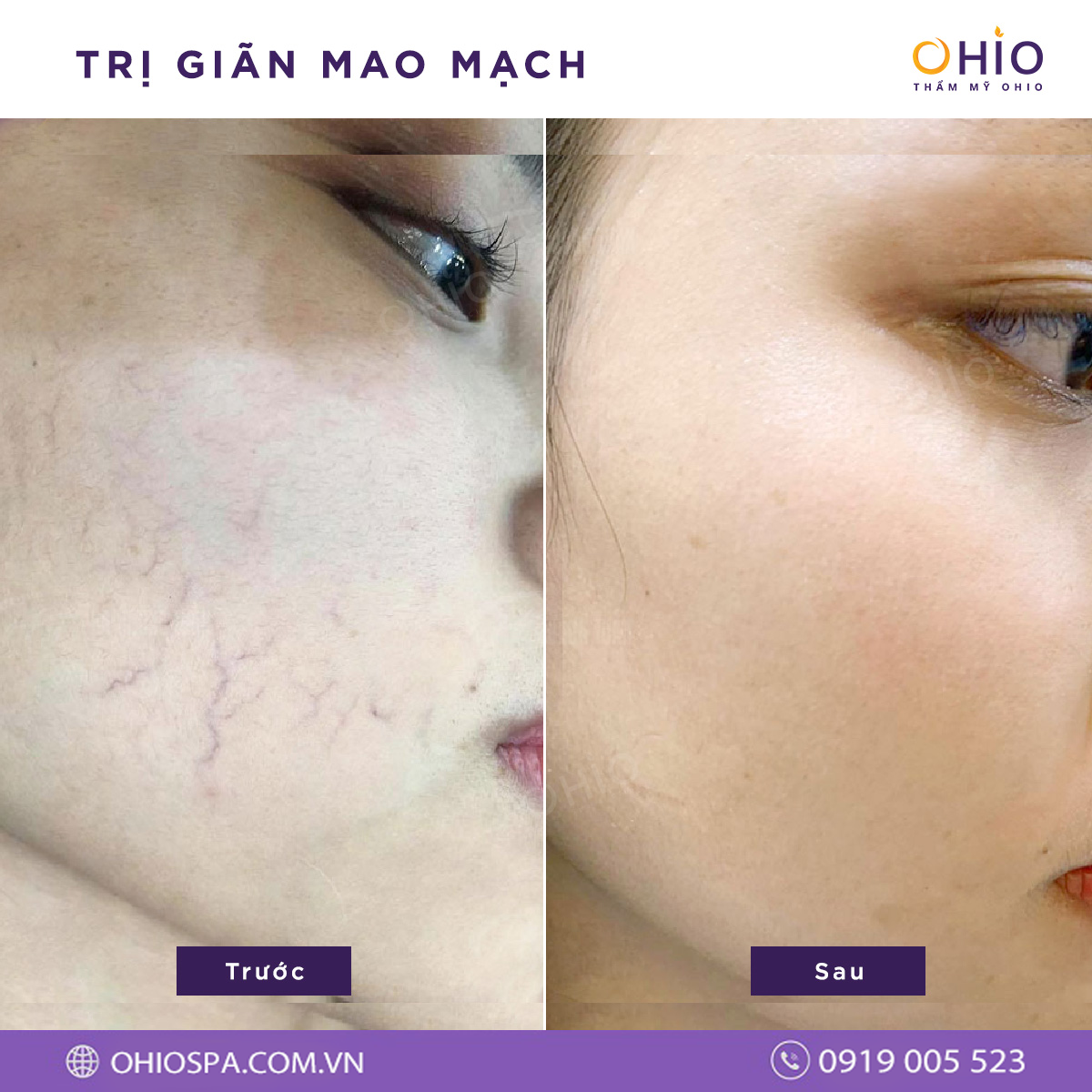 Giãn mao mạch có nguy hiểm không & cách điều trị hiệu quả - Phòng khám da liễu OHIO Giãn mao mạch có nguy hiểm không & cách điều trị hiệu quả