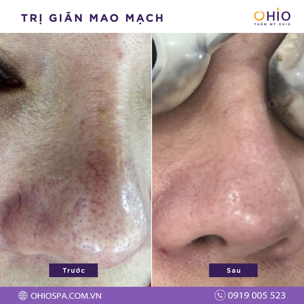 Giãn mao mạch có nguy hiểm không & cách điều trị hiệu quả - Phòng khám da liễu OHIO Giãn mao mạch có nguy hiểm không & cách điều trị hiệu quả