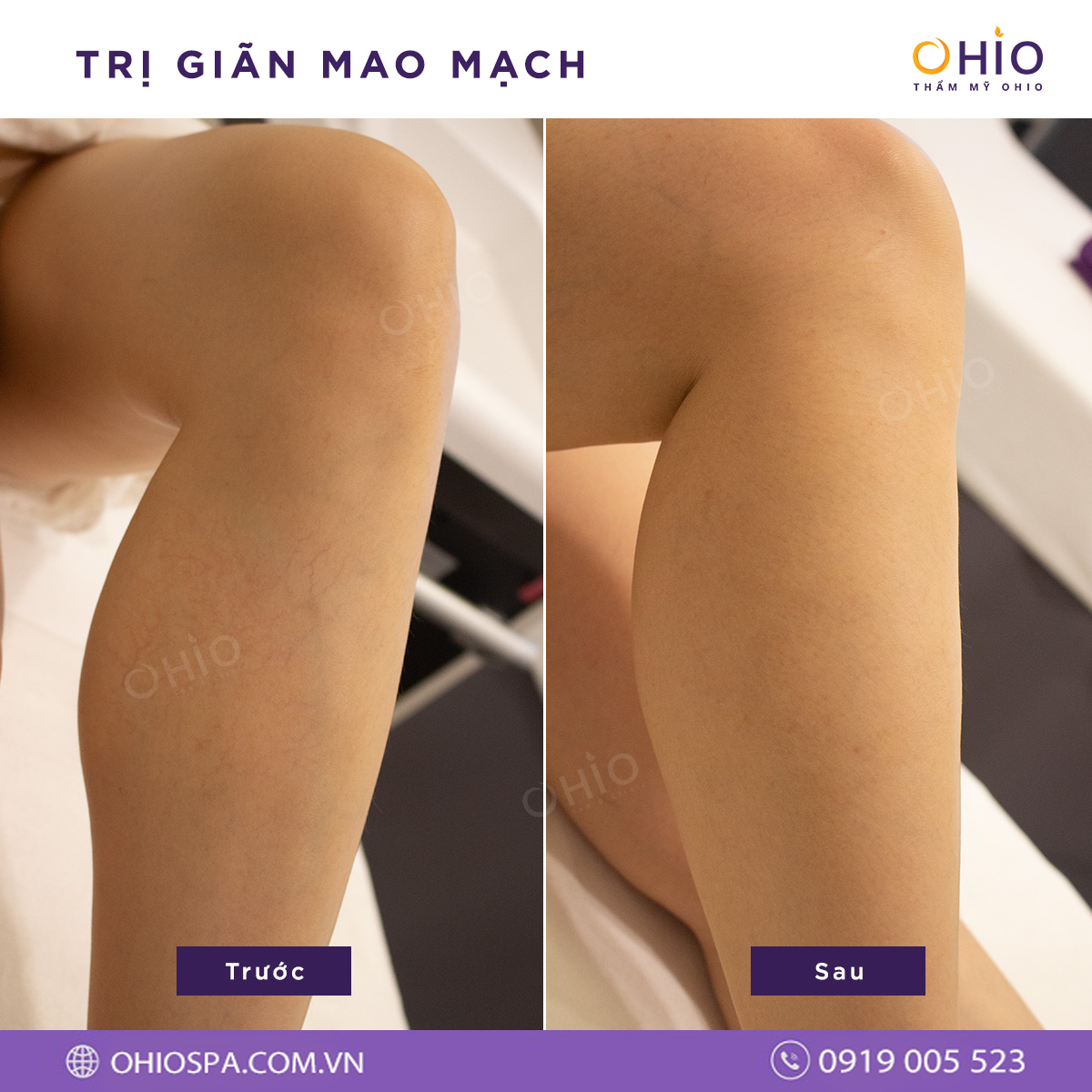 Giãn mao mạch có nguy hiểm không & cách điều trị hiệu quả - Phòng khám da liễu OHIO Giãn mao mạch có nguy hiểm không & cách điều trị hiệu quả