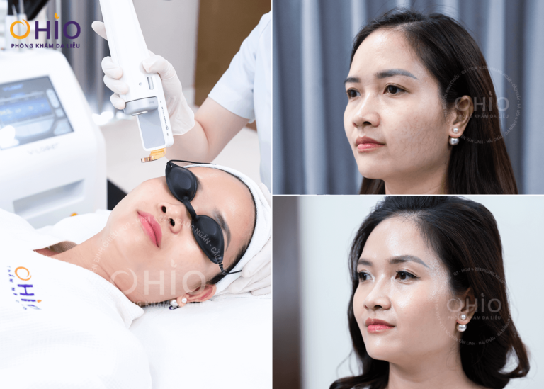 Dấu hiệu giãn mao mạch và cách điều trị an toàn, hiệu quả - Phòng khám da liễu OHIO Dấu hiệu giãn mao mạch và cách điều trị an toàn, hiệu quả