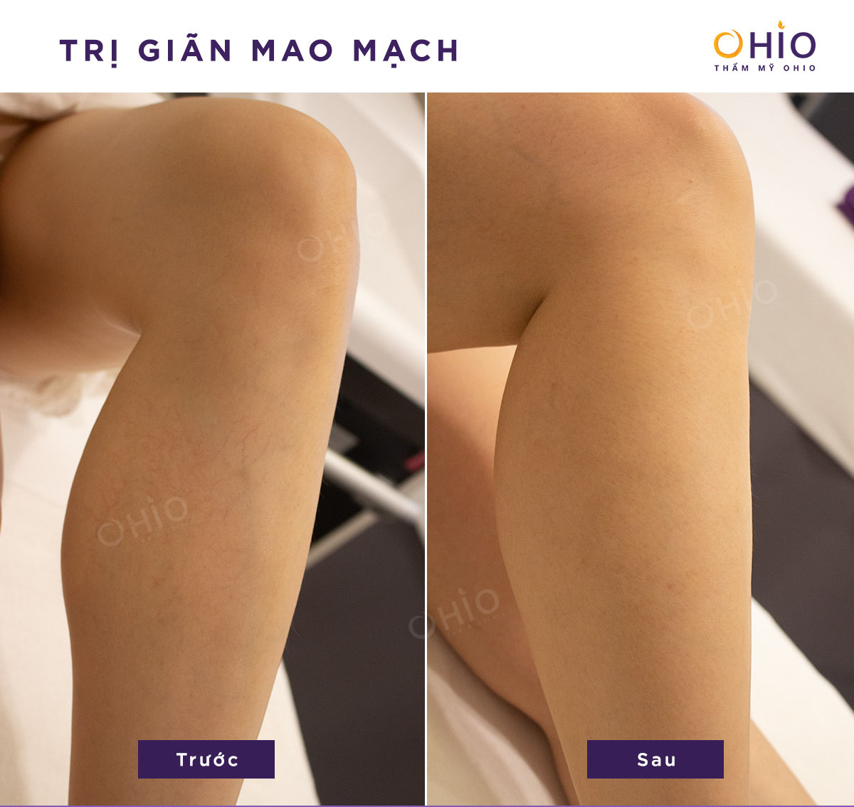 Trị giãn mao mạch bằng vớ y khoa có hiệu quả không? - Phòng khám da liễu OHIO Trị giãn mao mạch bằng vớ y khoa có hiệu quả không?