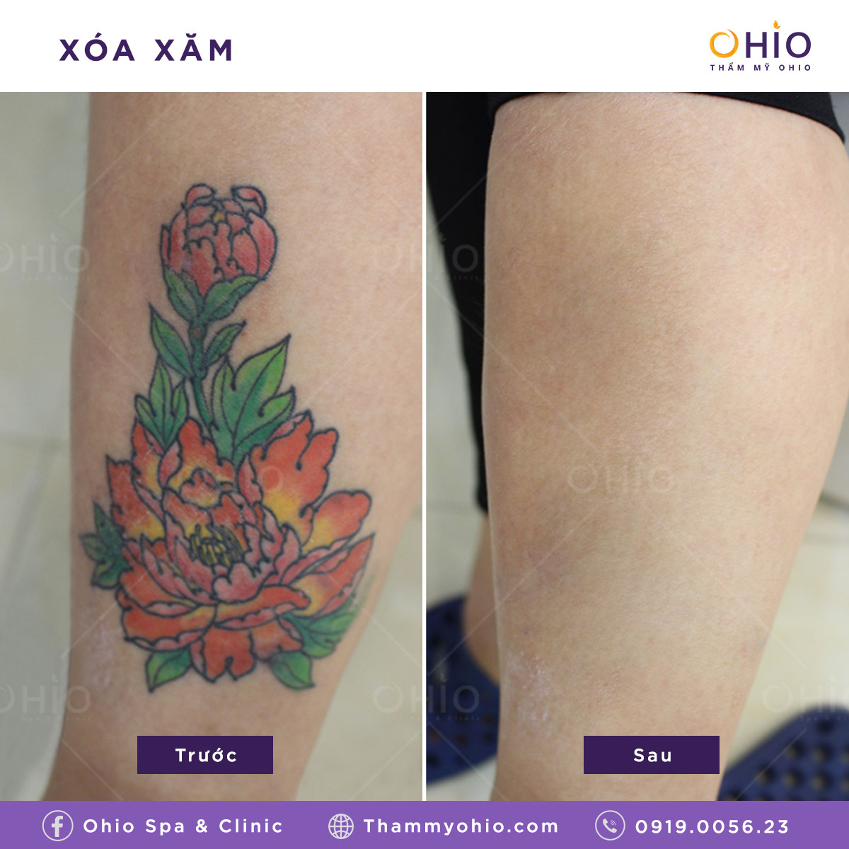 Những điều cần lưu ý khi xóa xăm thi ngành hàng không - Phòng khám da liễu OHIO xoa-xam-thi-nganh-hang-khong