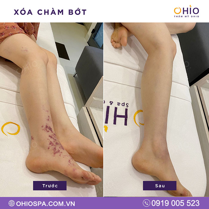 Review thực tế của khách hàng điều trị laser tại Thẩm mỹ OHIO - Phòng khám da liễu OHIO Review thực tế của khách hàng điều trị laser tại Thẩm mỹ OHIO