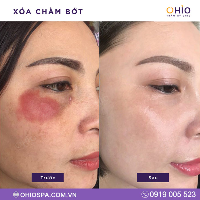 Review thực tế của khách hàng điều trị laser tại Thẩm mỹ OHIO - Phòng khám da liễu OHIO Review thực tế của khách hàng điều trị laser tại Thẩm mỹ OHIO
