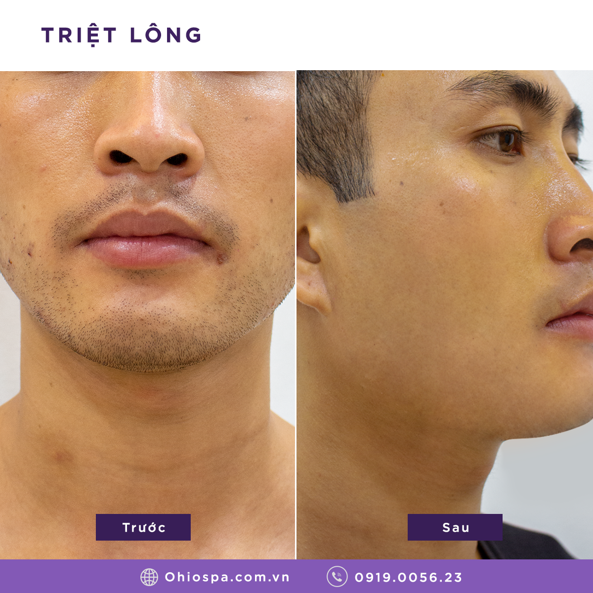 Triệt lông nam giới giá bao nhiêu? Công nghệ nào hiệu quả nhất? - Phòng khám da liễu OHIO Triệt lông nam giới giá bao nhiêu? Công nghệ nào hiệu quả nhất?