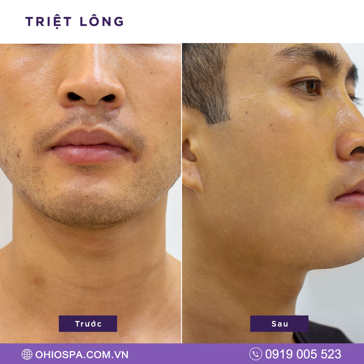 Triệt lông nam giới giá bao nhiêu? Công nghệ nào hiệu quả nhất? - Phòng khám da liễu OHIO Triệt lông nam giới giá bao nhiêu? Công nghệ nào hiệu quả nhất?