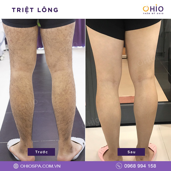 Triệt lông nam giới giá bao nhiêu? Công nghệ nào hiệu quả nhất? - Phòng khám da liễu OHIO Triệt lông nam giới giá bao nhiêu? Công nghệ nào hiệu quả nhất?