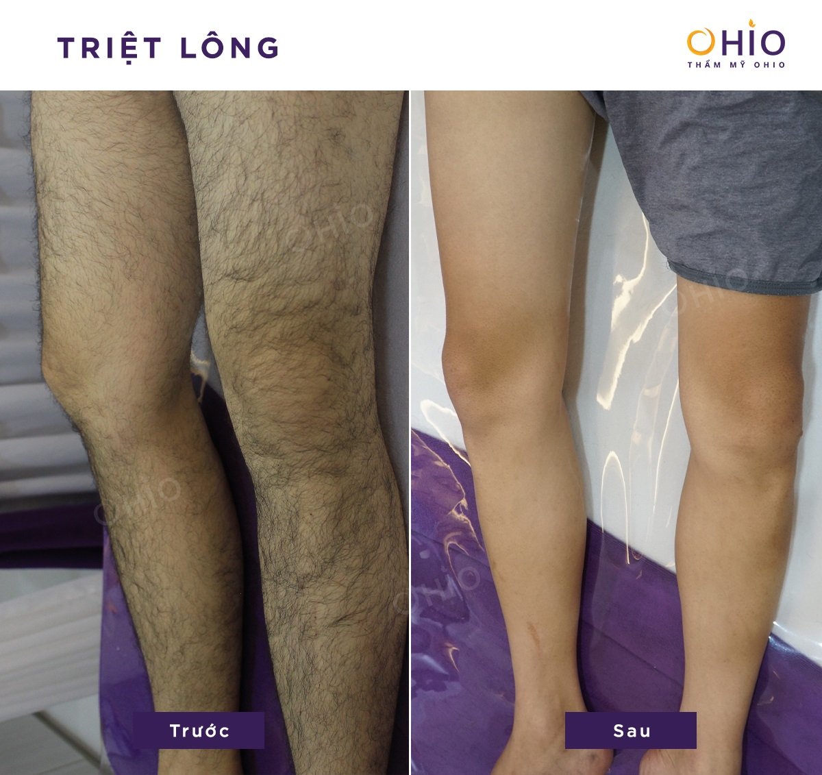 Hình ảnh đầy tự tin của khách hàng sau khi triệt lông tại Thẩm mỹ OHIO - Phòng khám da liễu OHIO Hình ảnh đầy tự tin của khách hàng sau khi triệt lông tại Thẩm mỹ OHIO