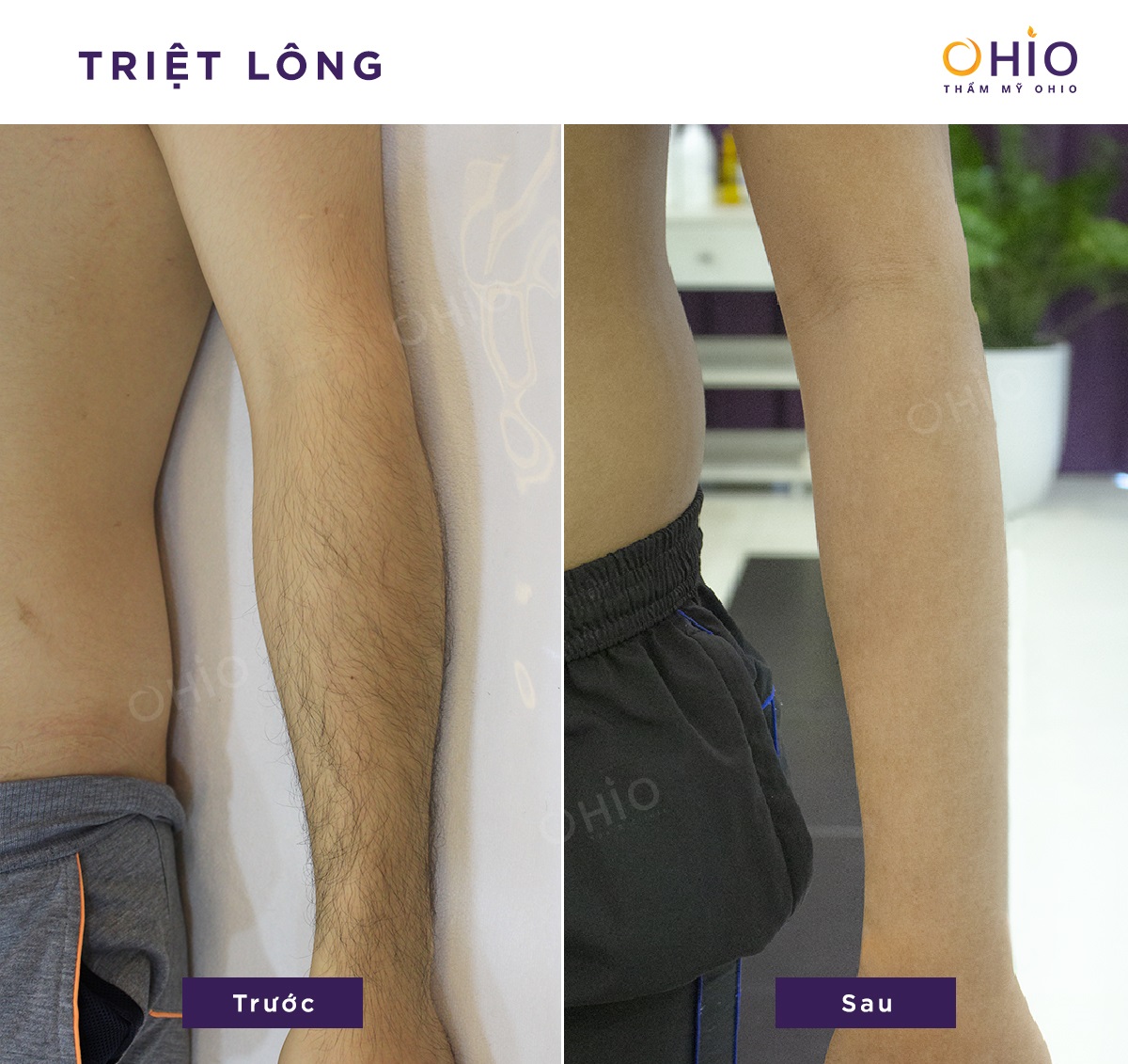 Hình ảnh đầy tự tin của khách hàng sau khi triệt lông tại Thẩm mỹ OHIO - Phòng khám da liễu OHIO Lông được triệt tiêu một cách