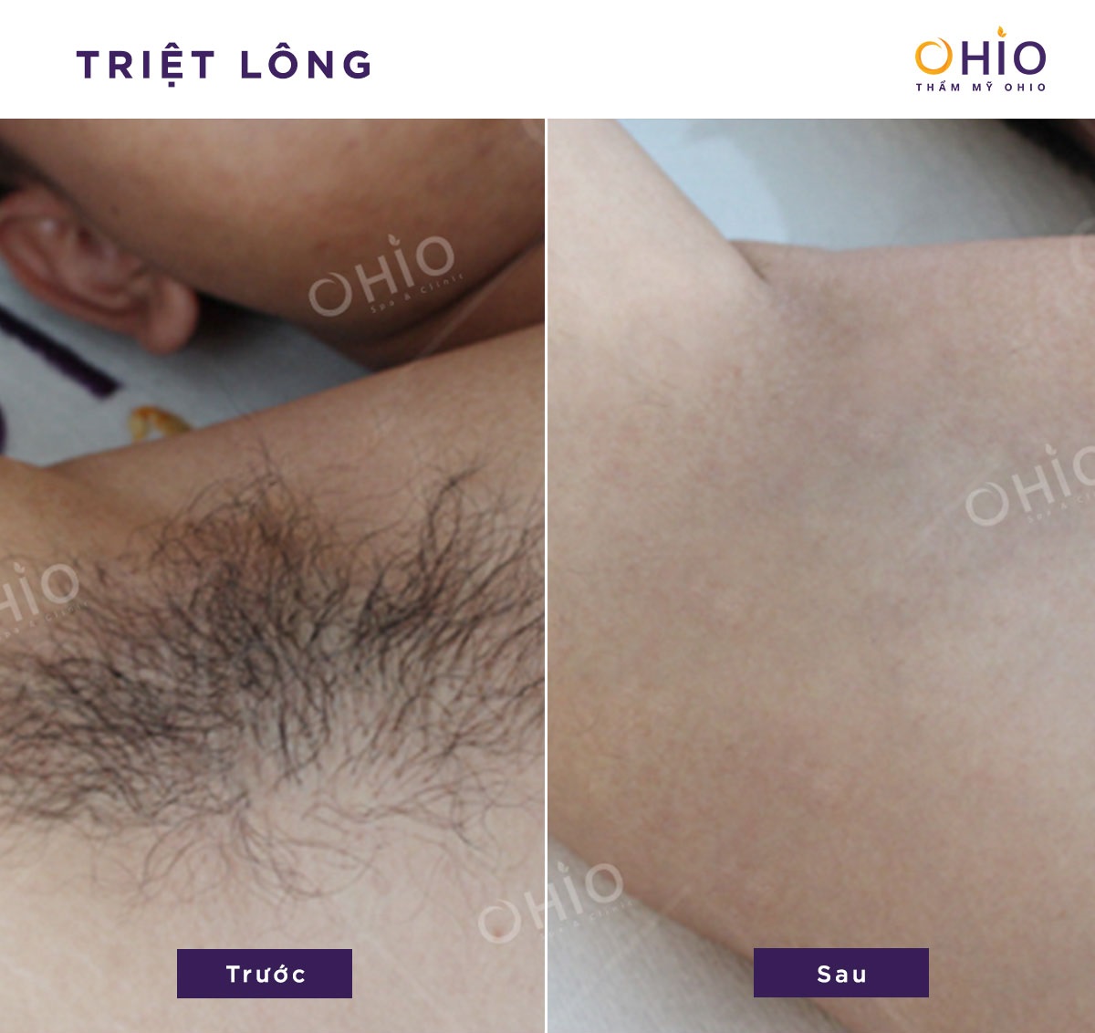 Hình ảnh đầy tự tin của khách hàng sau khi triệt lông tại Thẩm mỹ OHIO - Phòng khám da liễu OHIO Hình ảnh đầy tự tin của khách hàng sau khi triệt lông tại Thẩm mỹ OHIO