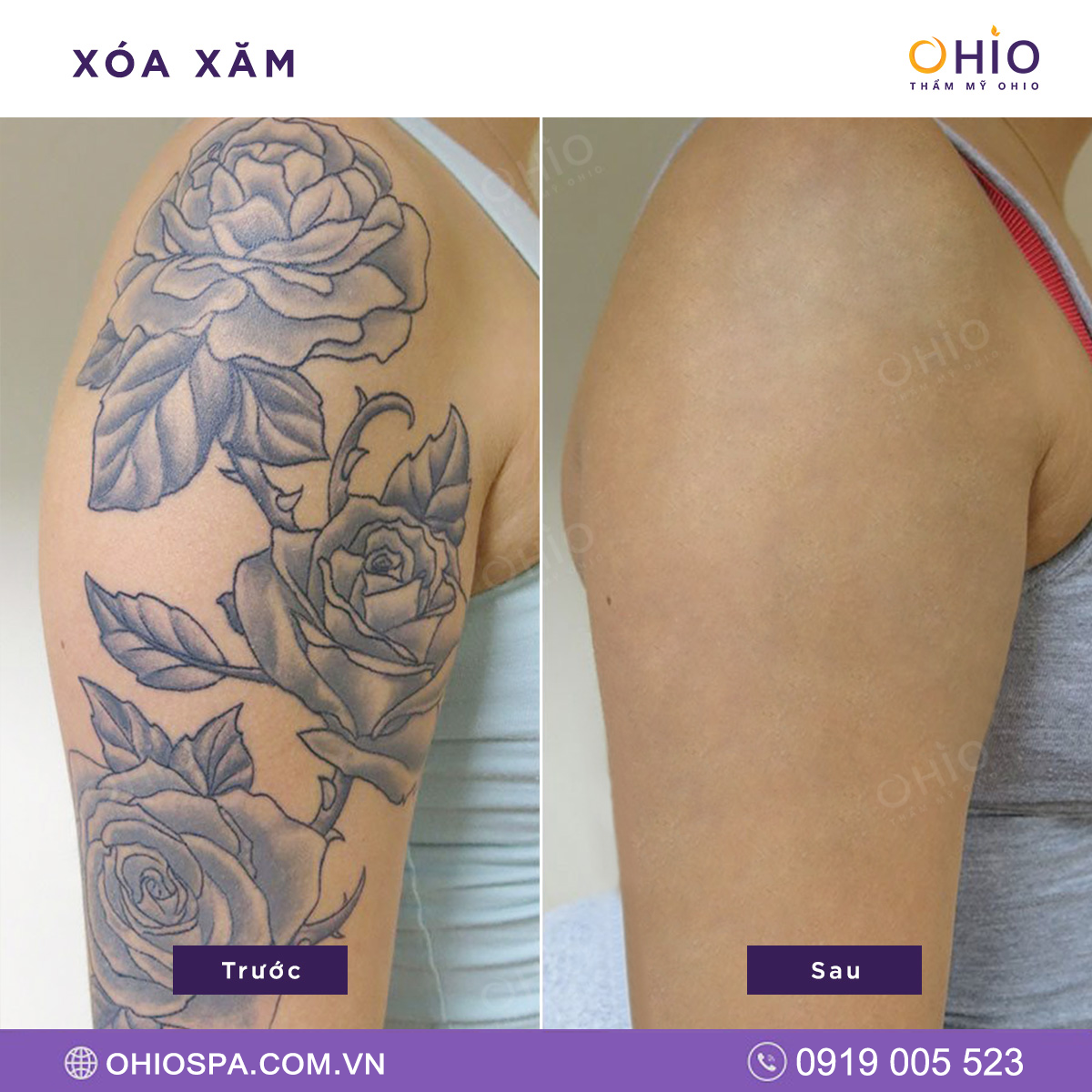 địa chỉ xóa xăm tại Hà Nội 4
