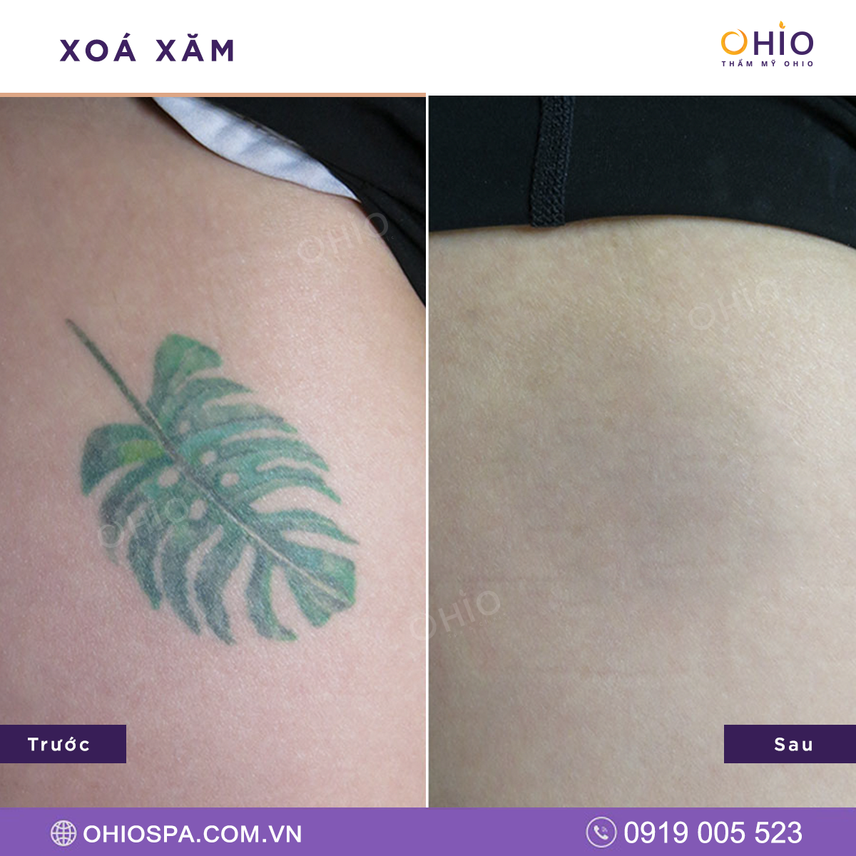 địa chỉ xóa xăm tại Hà Nội 5