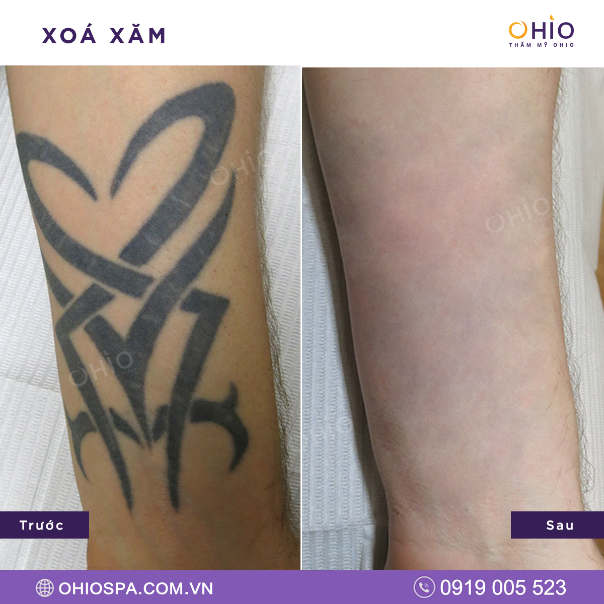 địa chỉ xóa xăm tại Hà Nội 6