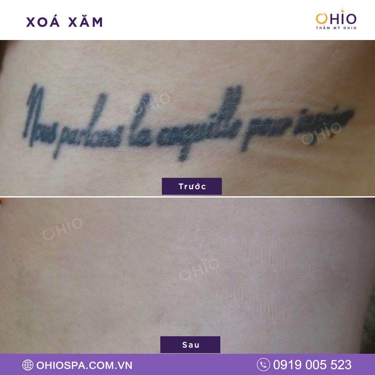 Địa chỉ xóa xăm tại Hà Nội uy tín, an toàn,