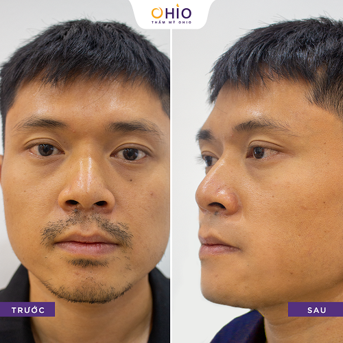 Tổng hợp những hình ảnh vui nhộn khi đàn ông để lông râu nhìn chỉ muốn triệt gọn - Phòng khám da liễu OHIO Triệt lông râu công nghệ AQUA MAX 4