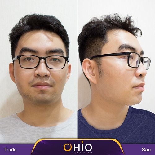 Tổng hợp những hình ảnh vui nhộn khi đàn ông để lông râu nhìn chỉ muốn triệt gọn - Phòng khám da liễu OHIO Triệt lông râu công nghệ AQUA MAX 3