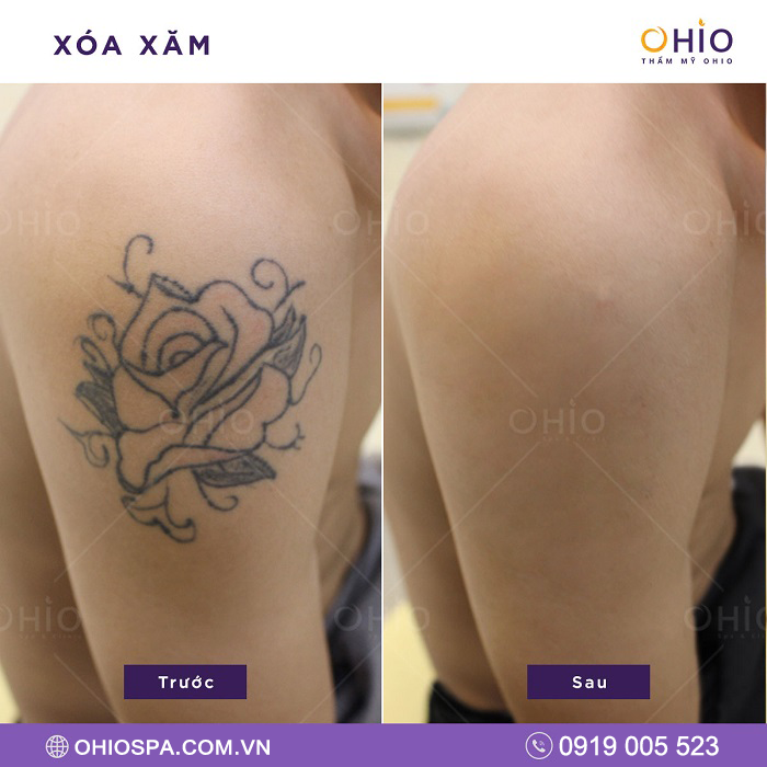 Địa chỉ xóa xăm uy tín, khách hàng tin chọn nhiều tại Hà Nội - Phòng khám da liễu OHIO Địa chỉ xóa xăm uy tín, khách hàng tin chọn nhiều tại Hà Nội