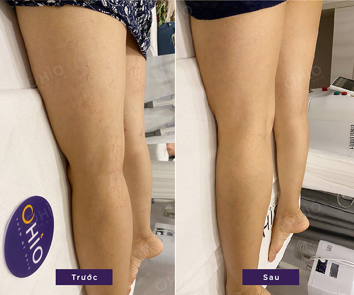 Trị giãn mao mạch chân do đứng lâu ngồi nhiều tại thẩm mỹ Ohio