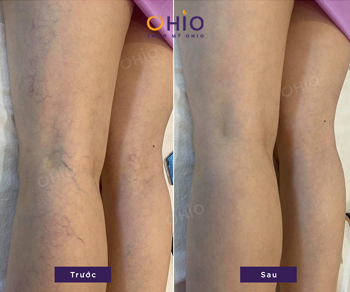 Trị giãn mao mạch chân do đứng lâu ngồi nhiều tại thẩm mỹ Ohio