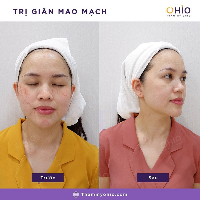Sau phẫu thuật thẩm mỹ bị giãn mao mạch phải làm sao? - Phòng khám da liễu OHIO Kết quả trị giãn mao mạch sau phẫu thuật