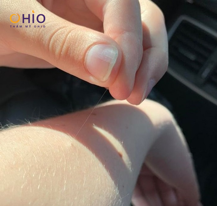 Vì sao có một số sợi lông dài mọc “BẤT THƯỜNG” trên cơ thể? - Phòng khám da liễu OHIO Lông tài có ảnh hưởng đến sức khỏe & tài vận không?