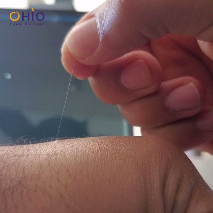 Vì sao có một số sợi lông dài mọc “BẤT THƯỜNG” trên cơ thể? - Phòng khám da liễu OHIO Tại sao có số sợi lông dài trên cơ thể?
