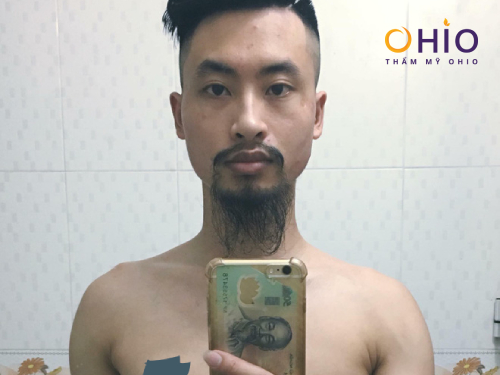Tổng hợp những hình ảnh vui nhộn khi đàn ông để lông râu nhìn chỉ muốn triệt gọn - Phòng khám da liễu OHIO Tổng hợp 10 bộ râu nhìn chỉ muốn triệt gọn 2