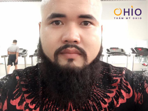Tổng hợp những hình ảnh vui nhộn khi đàn ông để lông râu nhìn chỉ muốn triệt gọn - Phòng khám da liễu OHIO Tổng hợp 10 bộ râu nhìn chỉ muốn triệt gọn 1