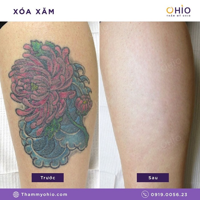 Tổng hợp những hình ảnh xóa xăm mãn nhãn tại Thẩm mỹ OHIO - Phòng khám da liễu OHIO Tổng hợp hình xăm mãn nhãn 5