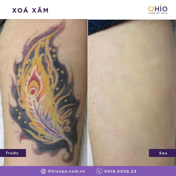Tổng hợp những hình ảnh xóa xăm mãn nhãn tại Thẩm mỹ OHIO - Phòng khám da liễu OHIO Tổng hợp hình xăm mãn nhãn 4