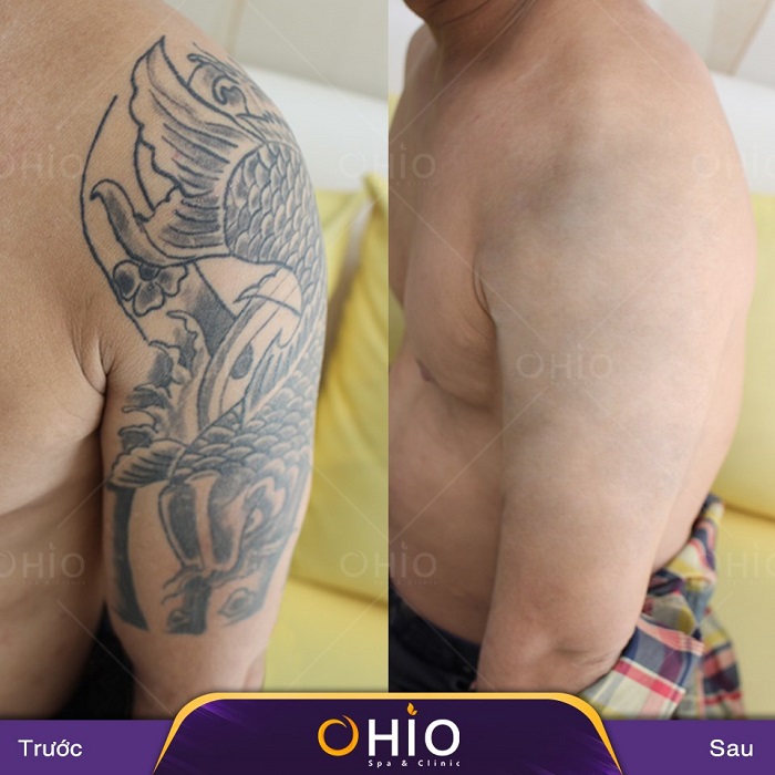 Tổng hợp những hình ảnh xóa xăm mãn nhãn tại Thẩm mỹ OHIO - Phòng khám da liễu OHIO Tổng hợp hình xăm mãn nhãn 8