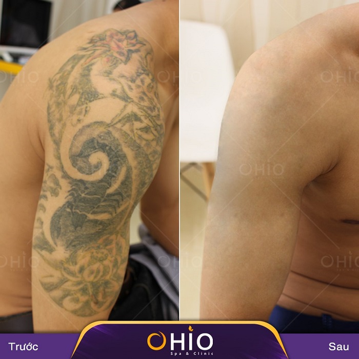 Tổng hợp những hình ảnh xóa xăm mãn nhãn tại Thẩm mỹ OHIO - Phòng khám da liễu OHIO Tổng hợp hình xăm mãn nhãn 7