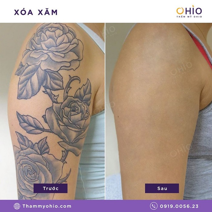 Tổng hợp những hình ảnh xóa xăm mãn nhãn tại Thẩm mỹ OHIO - Phòng khám da liễu OHIO Tổng hợp hình xăm mãn nhãn 2