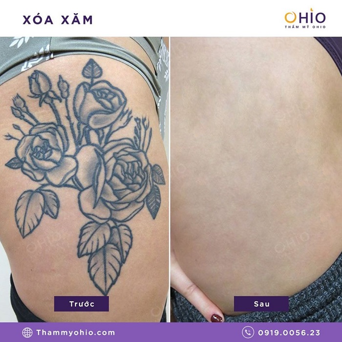 Tổng hợp những hình ảnh xóa xăm mãn nhãn tại Thẩm mỹ OHIO - Phòng khám da liễu OHIO Tổng hợp hình xăm mãn nhãn 3
