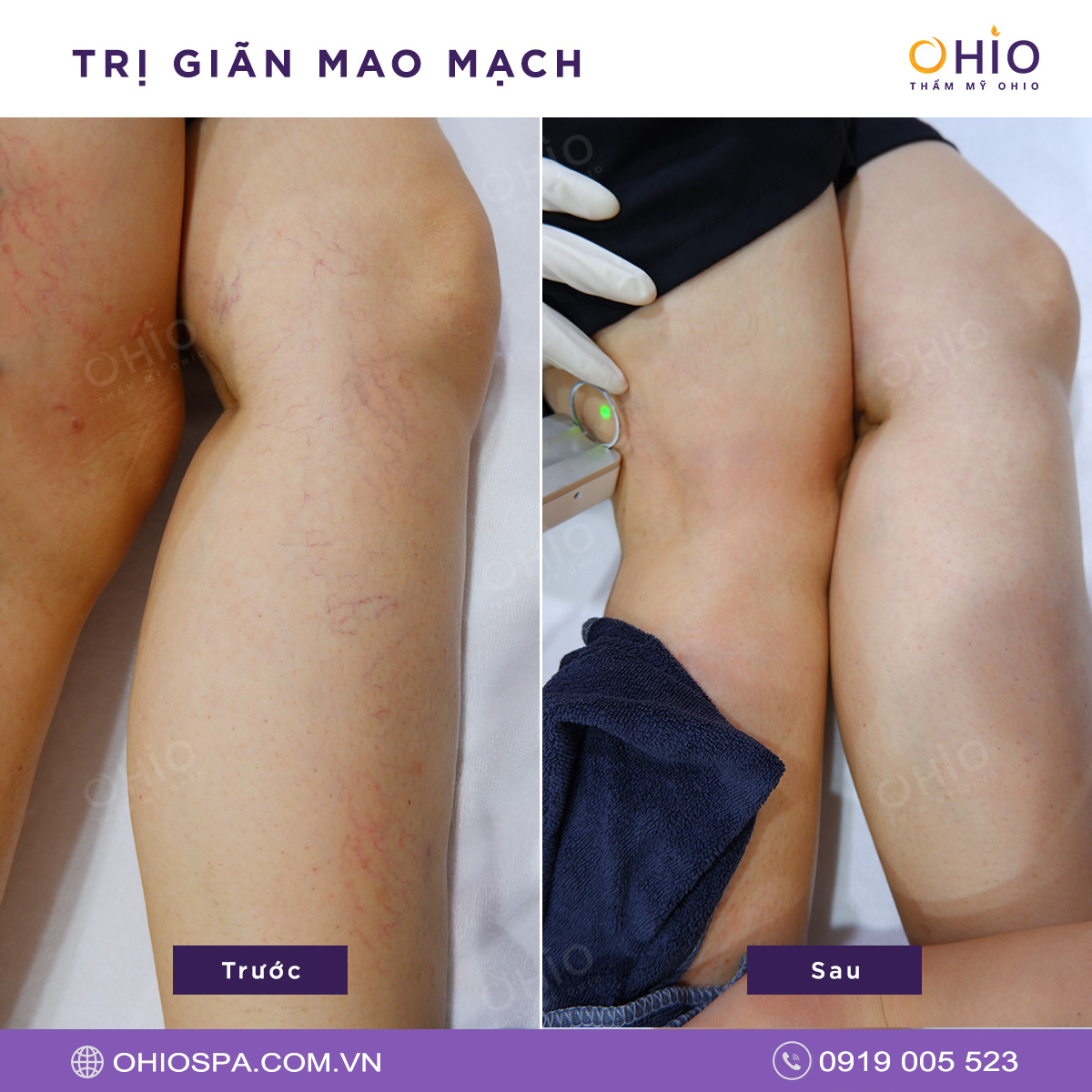 Những lưu ý quan trọng khi trị giãn mao mạch ở người lớn tuổi - Phòng khám da liễu OHIO Những lưu ý quan trọng khi trị giãn mao mạch ở người lớn tuổi